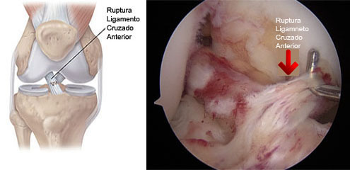 Reconstrucción del Ligamento Cruzado Anterior por el Dr. Aldo Bauza en CDMX
